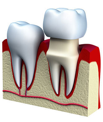 Dental crown graphic
