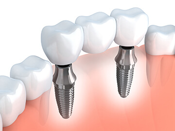 Implant-Supported Bridge