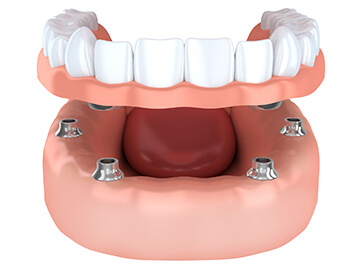 Overdenture