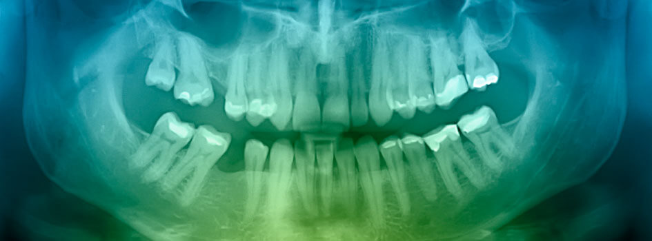 dental x-ray