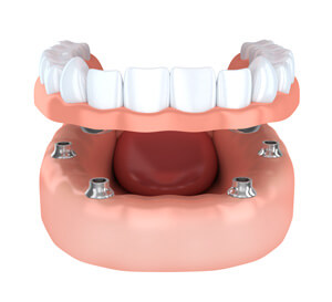 Dentures graphic