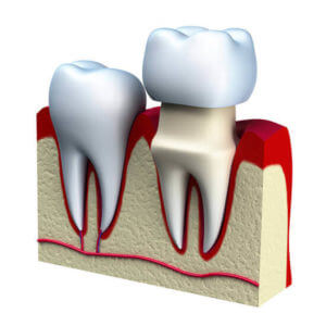 Dental crown graphic