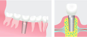 Dental implant illustration showing the implant fused with the bone on the left and topped with a dental crown on the right