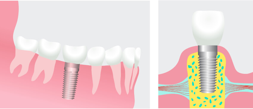 Dental implant illustration showing the implant fused with the bone on the left and topped with a dental crown on the right