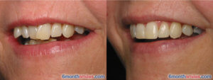 Before and after smiles images showing crooked teeth transformed into a straight smile