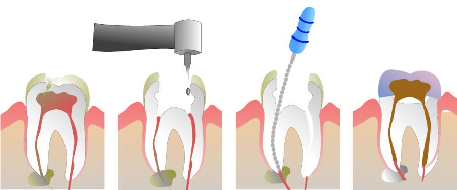 Graphic illustration of the steps involved to remove infection from the tooth's pulp in root canal therapy