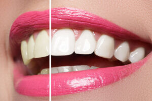 Close up of a smile brightened on half by professional dental teeth whitening.