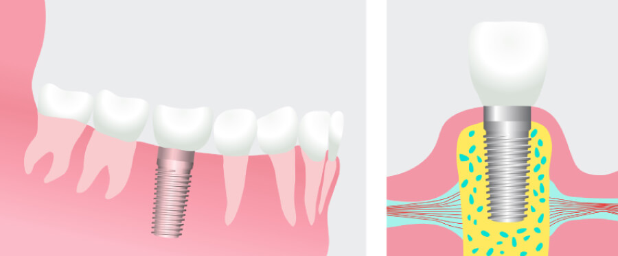 Model showing a dental implant in the lower jaw.