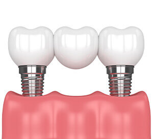 Dental Bridge Graphic