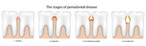 Stages of gum disease shown in a graphic.