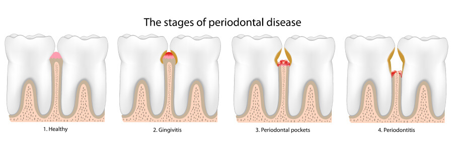Stages of gum disease shown in a graphic.