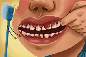 Cartoon of a patient with advanced gingivitis and bleeding gums.
