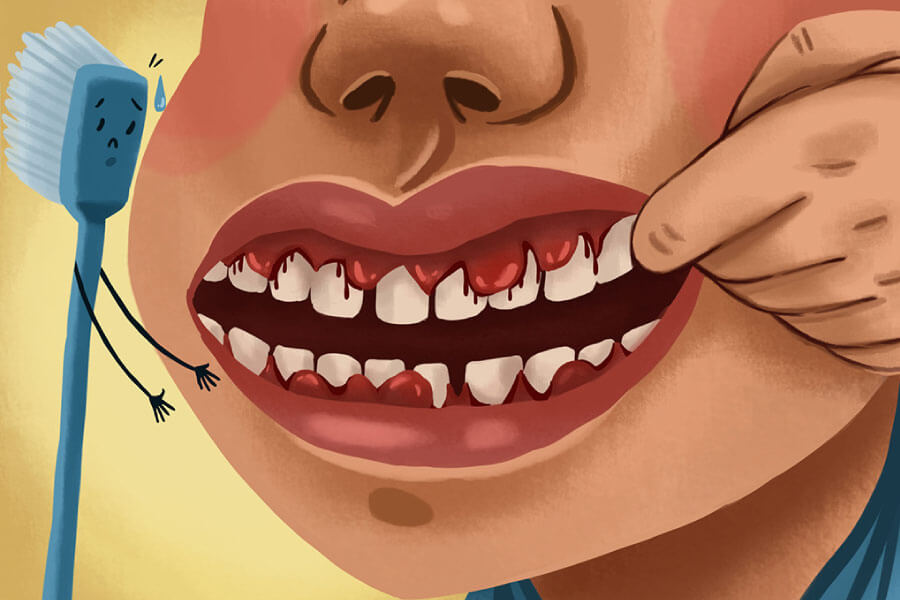 Cartoon of a patient with advanced gingivitis and bleeding gums.