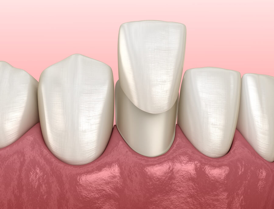 dental veneers, veneers, cosmetic dentistry