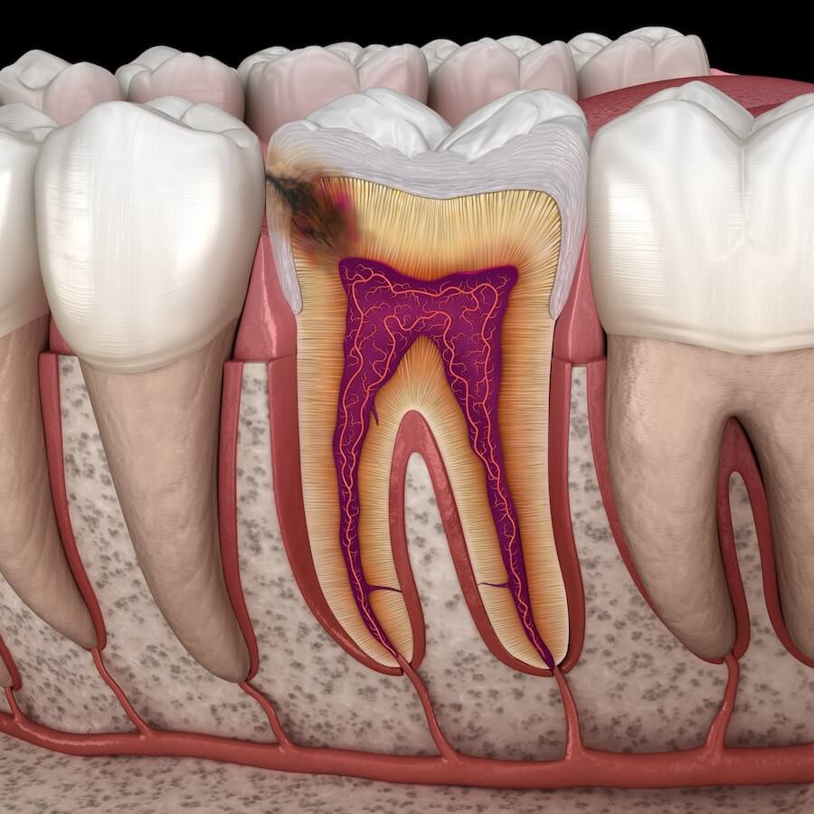 prone to cavities, genetic factors, sugar intake, oral hygiene, saliva production, oral microbiome, age and dental history, fluoride exposure, Springs Village Dentistry, Holly Springs, Dr. Diana Molta, Dr. Benjamin Moore